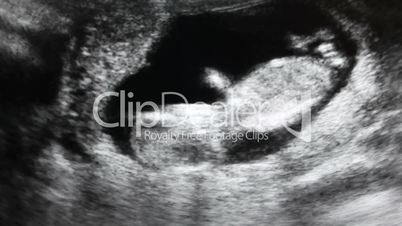 Fetus ultrasound scan