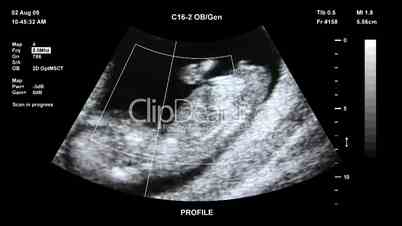 Fetus ultrasound scan
