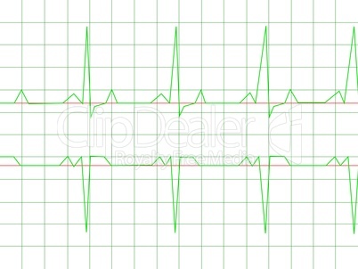 Normal Heart Rhythm