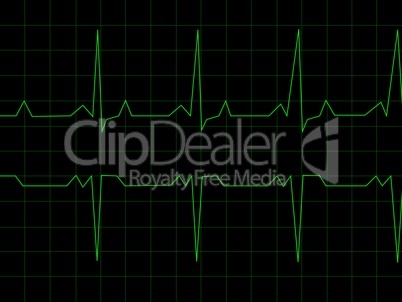 Normal Heart Rhythm