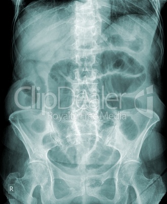 x-ray of the abdomen