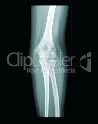 x-ray elbow