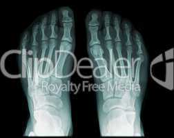 x-ray foot