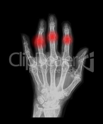 x-ray hand with pain
