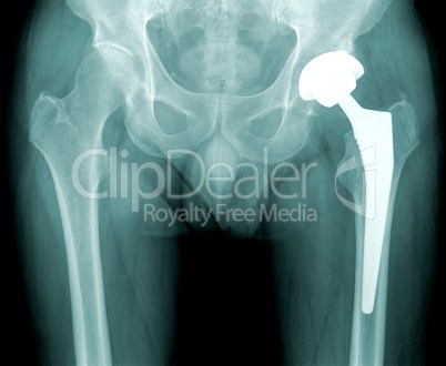 x-ray hip with total replacement