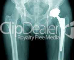 x-ray hip with total replacement