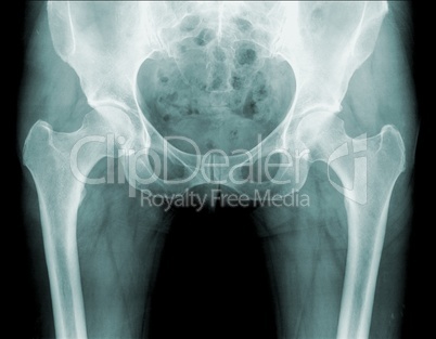 x-ray of a hip