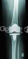 knee replacement