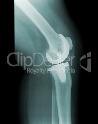 x-ray knee with total replacement