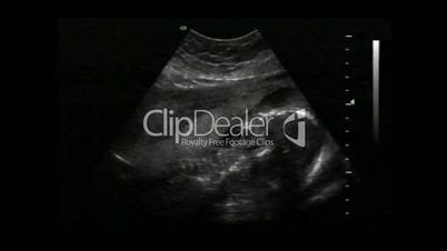 Utero Ultrasound