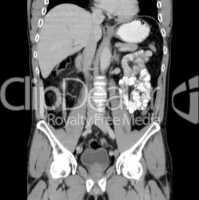 CT Abdomen