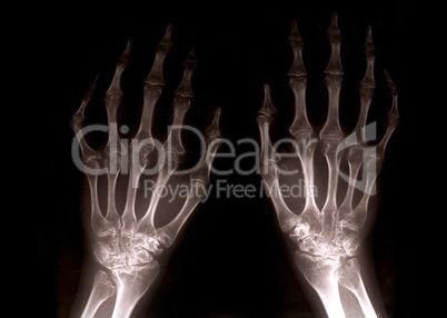 Xray hands