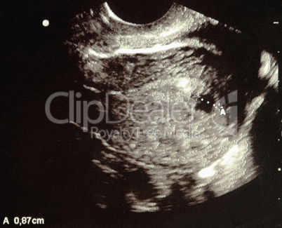 Ultrasound pregnancy