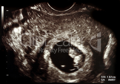 Ultrasound pregnancy