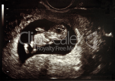 Ultrasound pregnancy