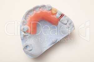 Zahnersatz - Prothese