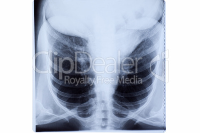Woman Chest X-ray