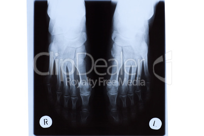 X-ray of Mature Woman Feet
