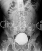 Intravenous pyelogram film of  kidney stone