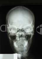 Human skull x-ray