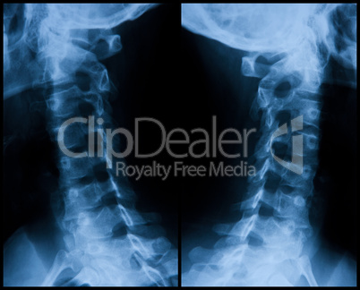 Cervical Radiograph - Left And Right