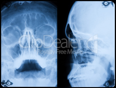 X-Ray Skull Front And Side Profile