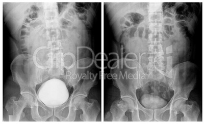 IVP film of patient with renal stone