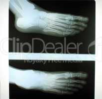 Human foot x-ray