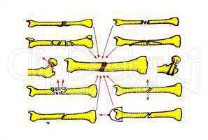 Frakturheilung/Fracture Healing