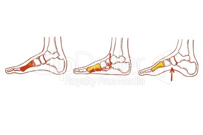 Fußknochen im Profil/Foot bone in profile
