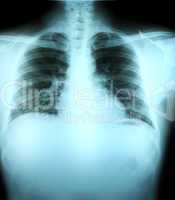 Adult chest x-ray