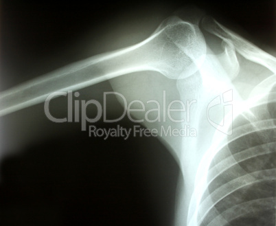 Shoulder joint x-ray