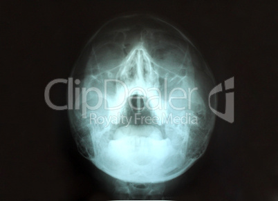 x-ray of sinuses