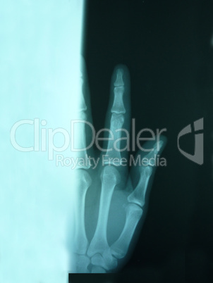 An x-ray of an index finger