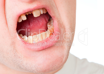 Young man face with broken tooth