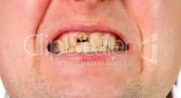 Young man mouth with broken tooth