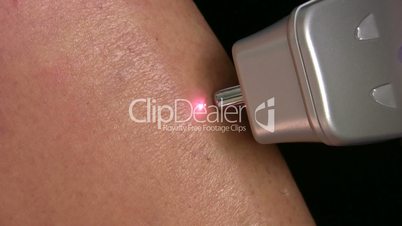 Laser epilation