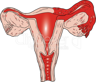 Inflammation of the uterus