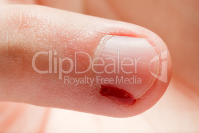 Blood wound finger nail