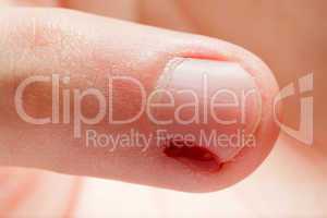 Blood wound finger nail