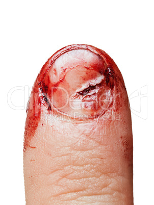 Blood wound finger nail