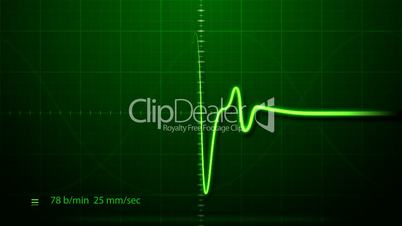EKG - Electrocardiogram