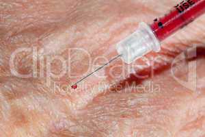 Injection into hand of senior male