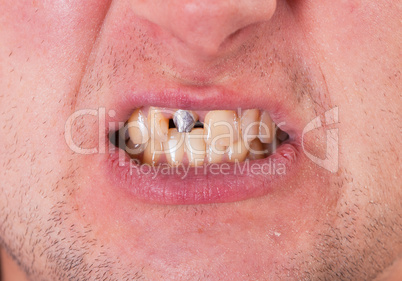 Young man face with tooth pin