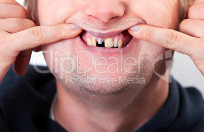 Young man face with broken tooth