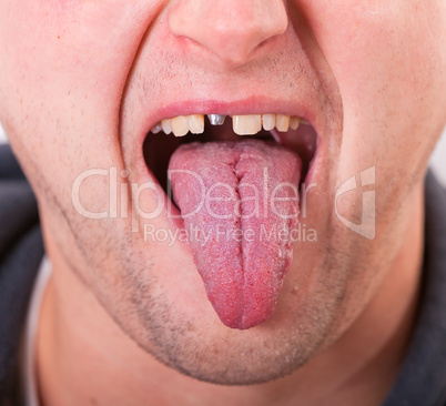 face with broken tooth and tongue