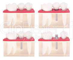 Implant dental model
