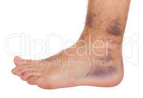 Ankle Sprain