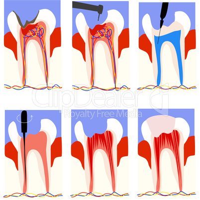 root canal therapy