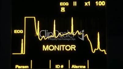 actual EKG monitor faster